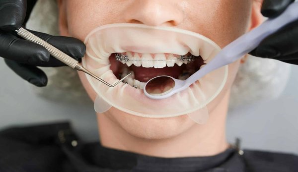 Avez-vous des conseils pour les appareils orthodontiques ?